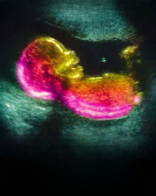 Could a Mother’s Gut Bacteria Affect Autism Risk? New Research Explores the Link