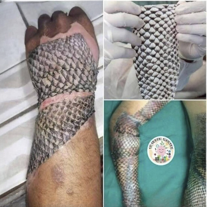 Tilapia Skin: A Revolutionary Alternative for Burn Recovery.