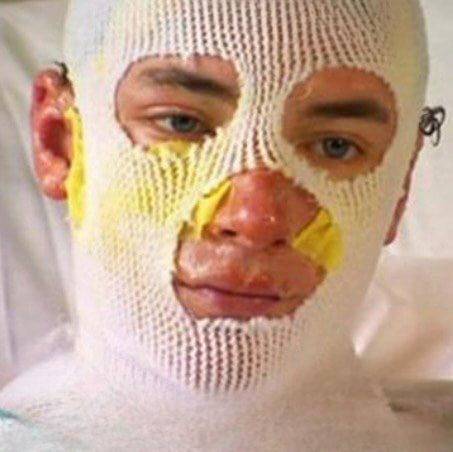 Uncle left with third-degree burn!